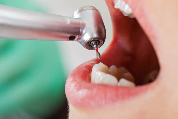 Best Emergency Root Canal Therapy in Blountsville, AL